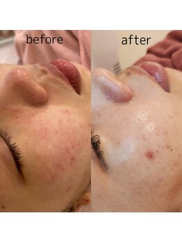 レイネイル レイエステティック 岐阜茜部店(RAY NAIL & RAY ESTHETIC)/肌質改善