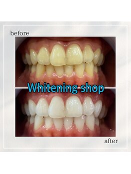 ホワイトニングショップ 岡山問屋町店/お客様のbefore&after