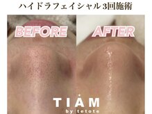 ル ポム バイ ティアム 神戸元町(Le pom by TIAM)/毛穴洗浄