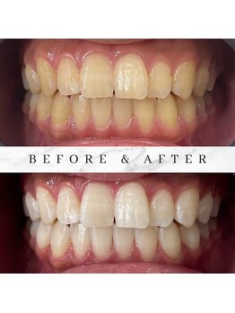 ユーラボ 表参道(YOU-LAB)/Befor/After【ホワイトニング】