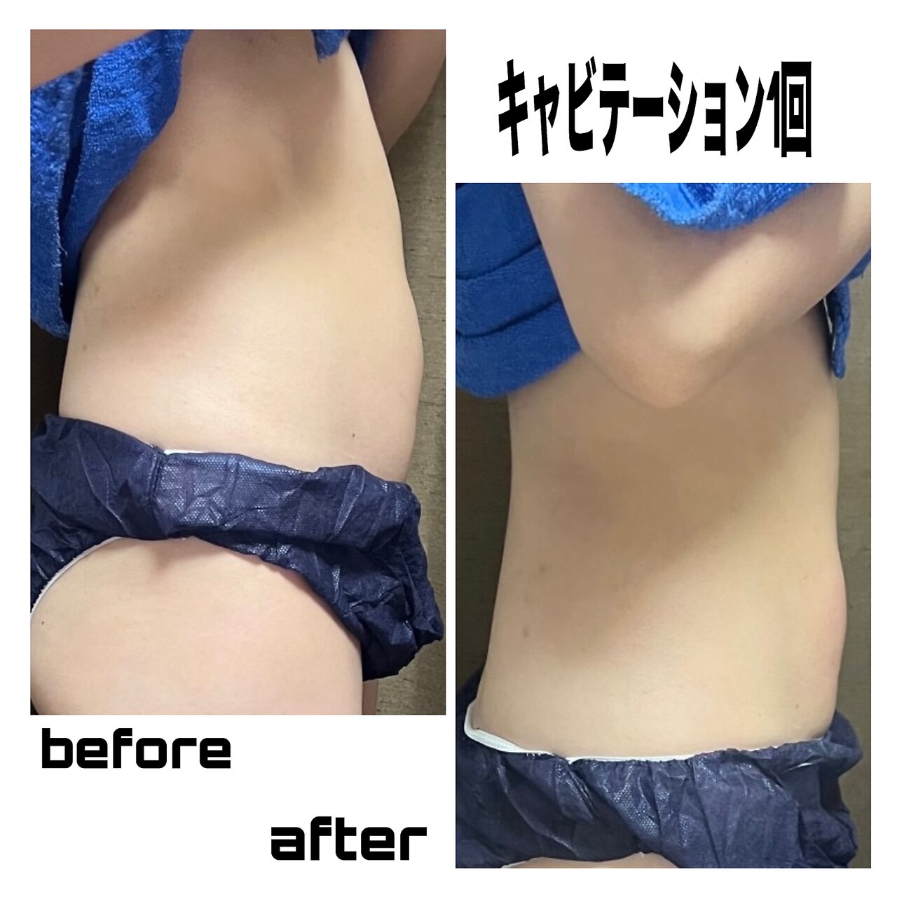 本格ダイエット！希望の部位を集中施術NO.1キャビテーション（レディース）