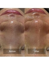 マヴィ(Mavie)/韓国式3D毛穴洗浄　