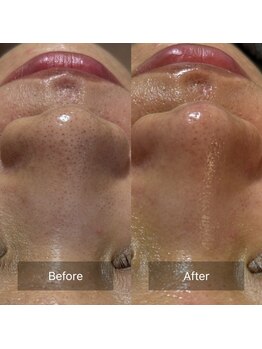 マヴィ(Mavie)/韓国式3D毛穴洗浄　