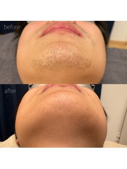 オンセ(once)/顔脱毛/全身脱毛