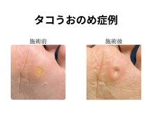 ドクターネイル爪革命 和歌山/胼胝魚の目