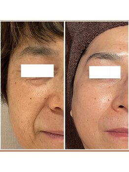 ピエルポゼ(Piereposer)/血流を整えて柔らかいお肌へ