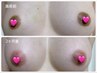 韓国式メラニンケア【ドールピンク】黒ずみ改善ピンク色の乳輪/乳頭￥32,000