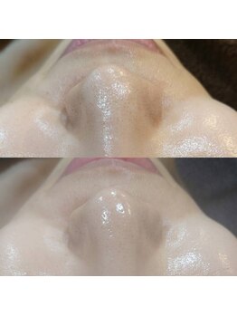 ボーソリューション(Beau-Solution)/【30代　毛穴の黒ずみ一発撃退】