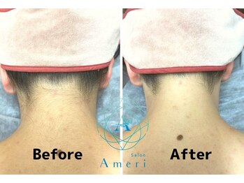サロンアメリ 高松丸亀町店(Salon Ameri)/香川　高松　全身脱毛　アメリ