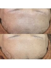 エーケー(AK)/水素パック