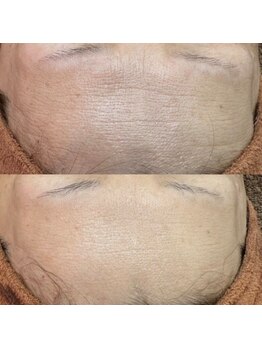 エーケー(AK)/水素パック