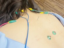 わきさか鍼灸整骨院・鍼灸院 レーヴ(Reve)の雰囲気（仕事・育児・家事で凝り固まった体に♪肩こり鍼灸♪）