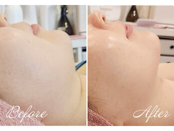 ヴィヴァン(Vivant)/プラズマ×EMS小顔フェイシャル