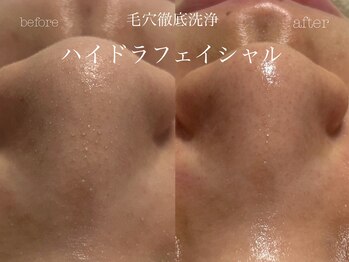 キアラ(CHIARA)/ハイドラフェイシャル