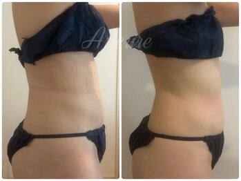 エルール トータルビューティ(Aileure total beauty)/術後DTケア お腹周り