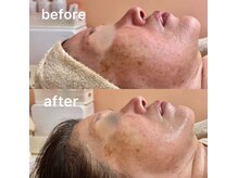 年齢不詳のハリ・艶のあるお肌へ導くことが得意です　成田市毛穴