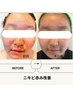 【ニキビにお悩みの方へ】非変性生プラセンタで一気に改善15800円→9800円
