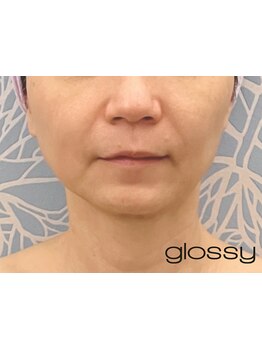 ホウレイ線・たるみ改善！予防ケア