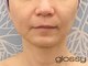 グロッシー(glossy)の写真/【シワ改善実績アリ】60代も若々しい印象に!プラズマ機器×ヒト幹細胞を経験豊富スタッフが扱うので効果◎