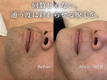 ダイヤ 名古屋中川区店(Daiya)/メンズ脱毛/ヒゲ【BeforeAfter】