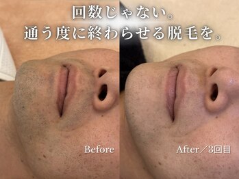 ダイヤ 名古屋中川区店(Daiya)/メンズ脱毛/ヒゲ【BeforeAfter】