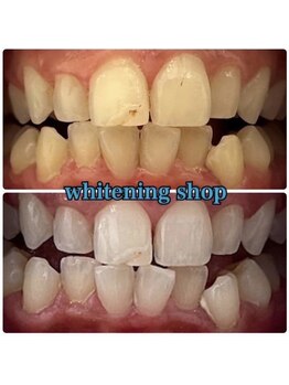 ホワイトニングショップ 大宮店/無加工の美白の歯をお届け！