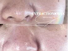 ワクシングトウキョウ アイス 池袋(waxing tokyo ice)/毛穴×脱毛