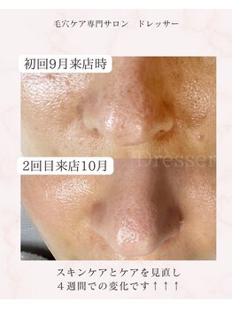 ドレッサー(Dresser)/取っての繰り返しの角栓悩みが