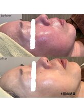 フォーユー マシバメディカル(For You Mashiba Medical)/赤み改善透明感あふれるお肌に！