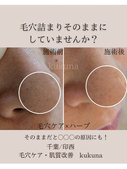 ククナ(kukuna)/毛穴×ハーブが人気です