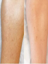 スキンラウンジ(SKIN LOUNGE)/圧倒的効果｜LED脱毛