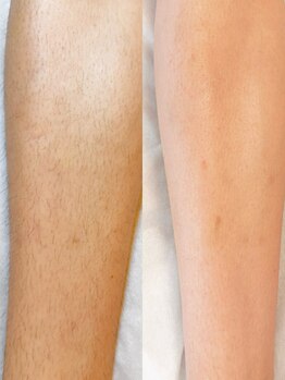 スキンラウンジ(SKIN LOUNGE)/圧倒的効果｜LED脱毛