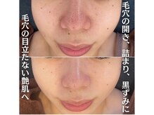 ファシル(Facile)の雰囲気（ハーブピーリング+毛穴洗浄）