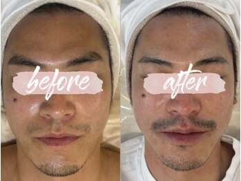 ミピマム 恵比寿店(Mipimam)/メンズ小顔