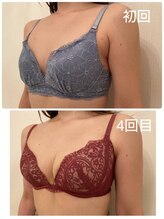 美人バスト 本厚木店/バストアップ◇症例◇