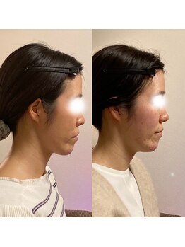 小顔22 ボルティ 本店(Bolty)/【面長=中顔面】が大きく変化