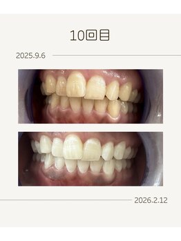 ホワイトニングショップ 福岡姪浜店/お客様before after