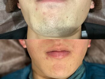 メンズ脱毛サロン ボス(BOSS)/清潔感をお求めの方必見！