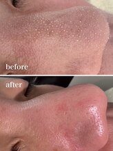 ニコ(nico)/毛穴/皮脂詰まり/角栓/ザラつき