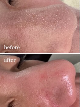 ニコ(nico)/毛穴/皮脂詰まり/角栓/ザラつき