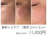 【まずはお試し】ポイントシミケア　1箇所2cm×2cm 22,000円→11,000円