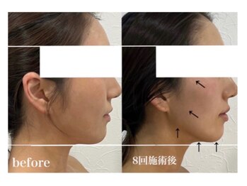 ベール(BEHL)/コルギのBeforeと８回施術後！