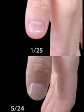 チャームドロップ/深爪、噛み爪補正