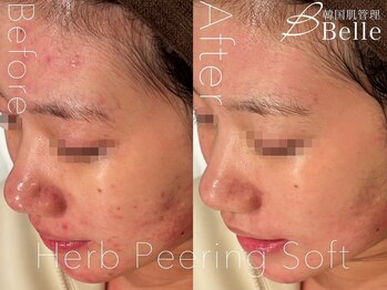 ベル 川崎(Belle)/ハーブピーリング｜ニキビケア