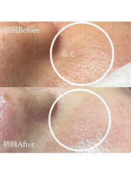 フレル(FUREL)/産毛も一切残さない!