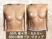 エクラパピヨン 荻窪(Eclatpapillon)/バストアップ＊施術例