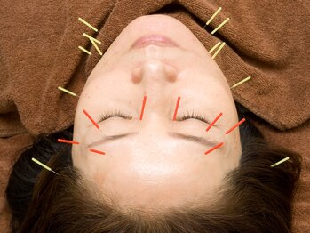 たかさきひかり鍼灸整骨院/お顔のお悩みに合わせた美容鍼