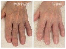 キレイテ 福岡天神店/50代/6回目【天神ハンドケア】