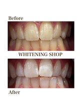 ホワイトニングショップ 守谷店(whitening shop)/ホワイトニング