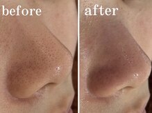 アイリーン(IRENE)/毛穴洗浄♪